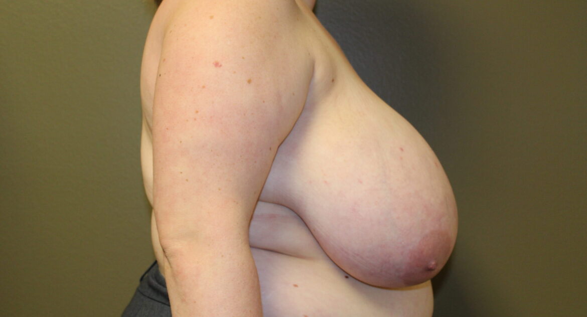 Woman with macromastia before breast reduction surgery
