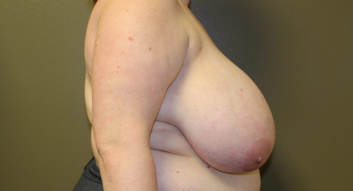 Woman with macromastia before breast reduction surgery