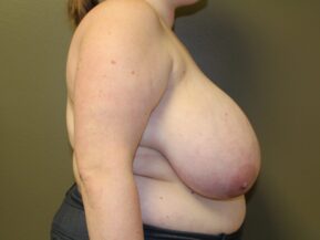 Woman with macromastia before breast reduction surgery