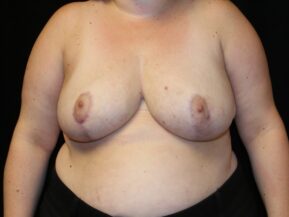 Woman after breast reduction surgery