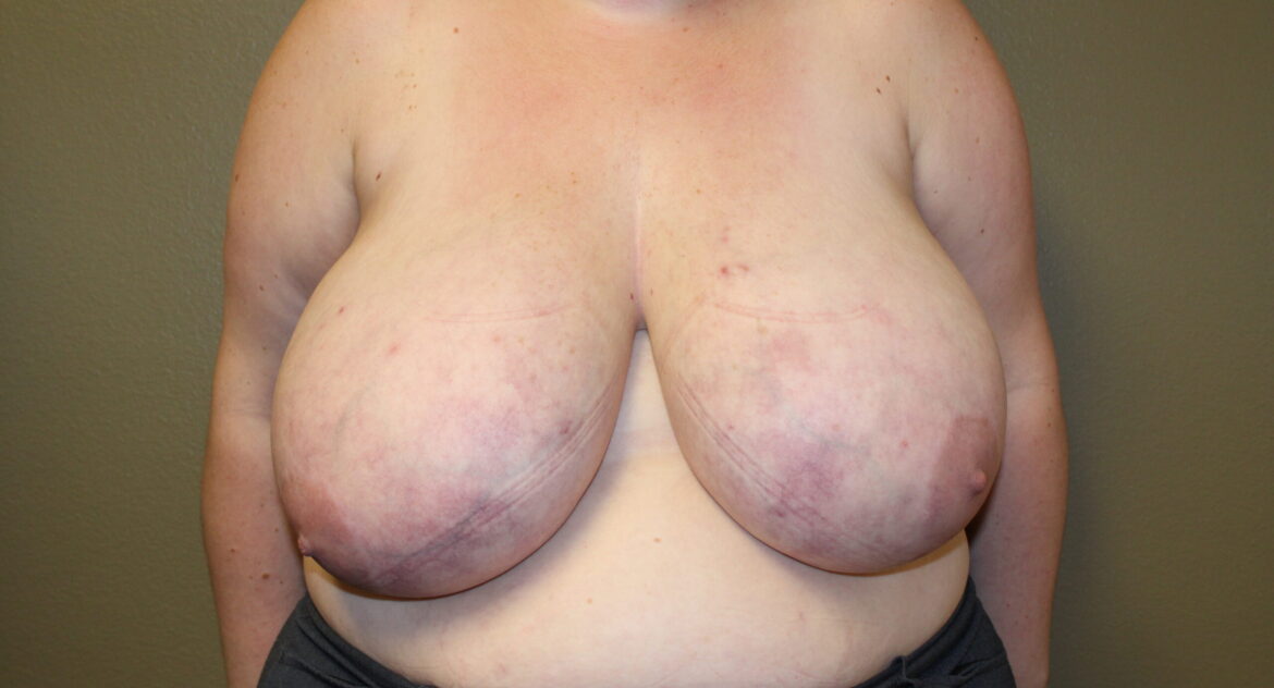 Woman with macromastia before a breast reduction