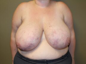 Woman with macromastia before a breast reduction