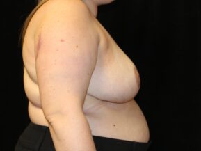 After breast reduction surgery