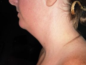 Profile of woman's face and neck before a MyEllevate neck lift