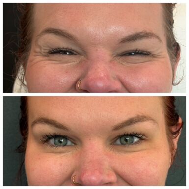 Two photos of a female patient's face showing before and after botox treatment, eliminating wrinkles near her eyes.