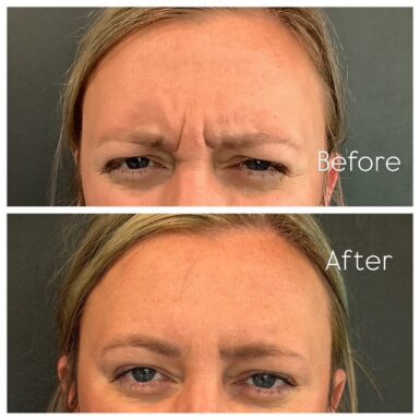 Two photos of a female patient's face showing before and after botox treatment, eliminating wrinkles between her eyes.