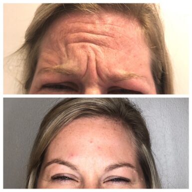 Two photos of a female patient's face showing before and after botox treatment, eliminating wrinkles on her forehead.