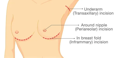 breast implant incision locations