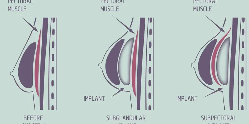 diagram showing where the breast implant is placed