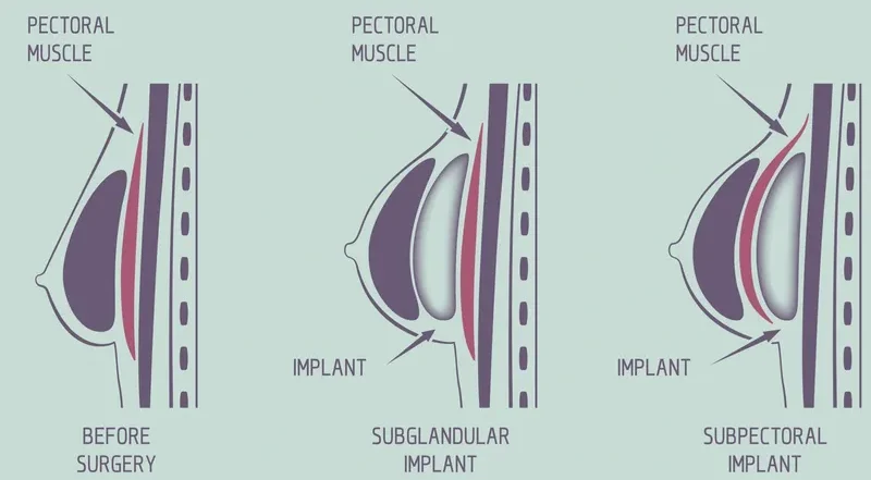 diagram showing breast implant placements for breast augmentation