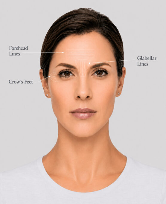 Dysport Treatment Areas A facial diagram highlighting common Dysport treatment areas, including forehead lines, glabellar lines, and crow’s feet, for wrinkle relaxer treatment planning.