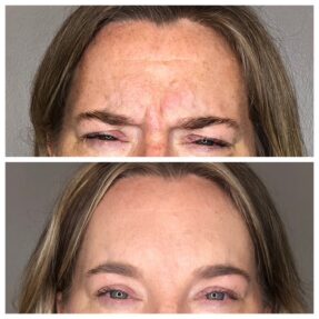 Dysport Before and After Photos Two photos of a female patient's face showing before and after dysport treatment, eliminating wrinkles on her forehead.