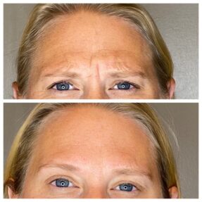 Before and After Photos for Dysport Two photos of a female patient's face showing before and after dysport, eliminating wrinkles on her forehead.