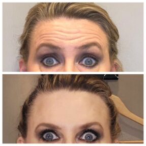 Before and After Dysport Photos Two photos of a female patient's face showing before and after dysport, reducing wrinkles on her forehead.