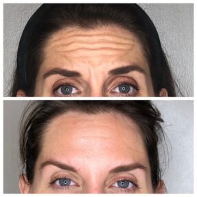 Dysport Before and After