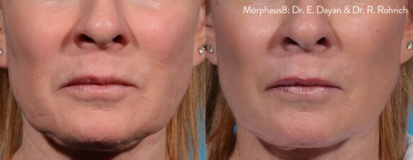 close up of before and after of fine lines removal