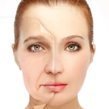 before and after facelift results