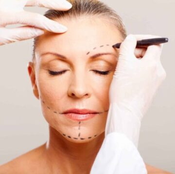surgeon drawing lines on woman's face for a facelift