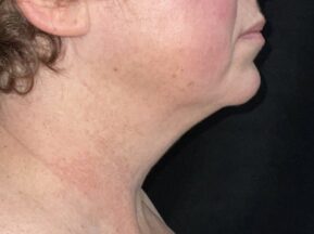 Profile of woman's face and neck before a MyEllevate neck lift