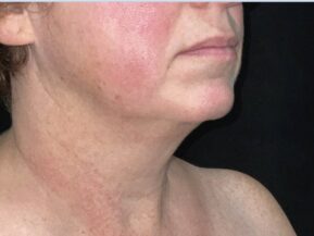 Profile of woman's face and neck after a MyEllevate neck lift