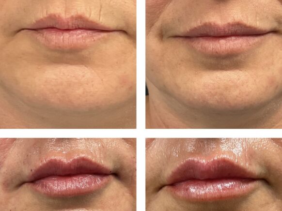 Juvederm Volbella Two pictures of a woman's lips before and two pictures after Juvederm Volbella injections