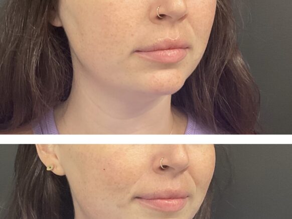 Juvederm Voluma Two pictures of a woman's mouth showing before and after Juvederm Voluma injections