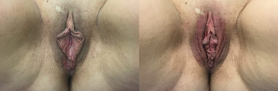 before and after vaginal rejuvenation