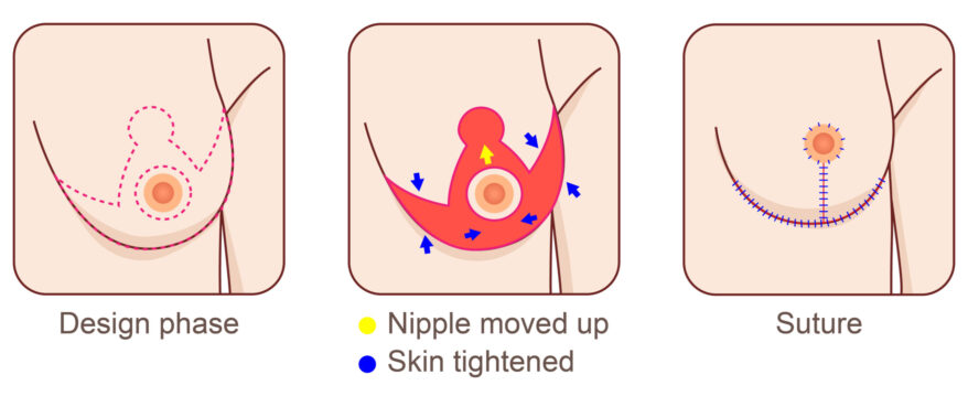 Diagram showing the three stages of breast lift after breast reduction surgery. Design phase, nipple moved up and skin tightened, and suture.
