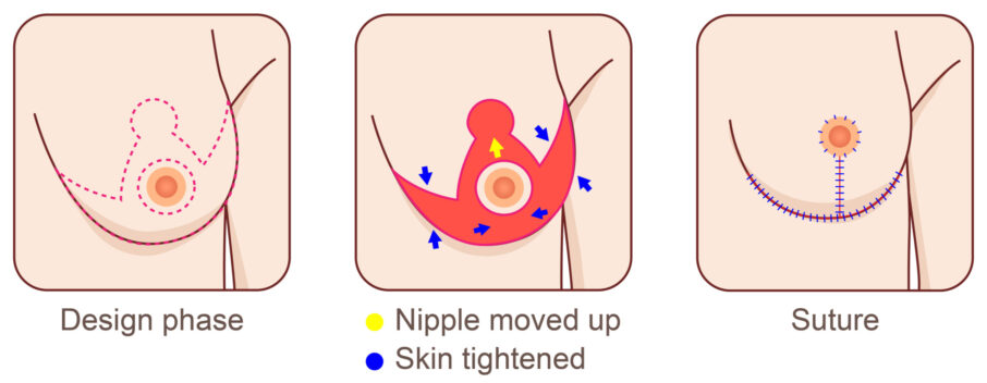 diagram showing the three stages of breast lift