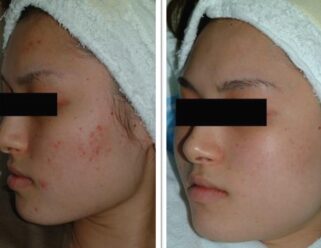 Before and after of acne scarring removal from skin lasers