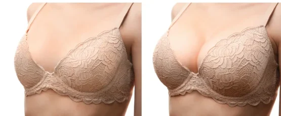 Two pictures, one on the left of a woman's breasts in a bra before breast augmentation surgery, and one on the right after breast augmentation surgery