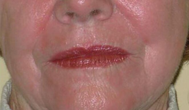 Up close of elderly woman's lower face showing lines and wrinkles to be treated from skin lasers