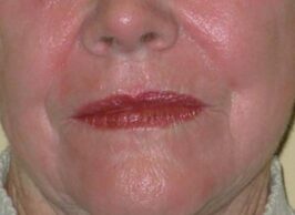 Up close of elderly woman's lower face showing lines and wrinkles to be treated from skin lasers