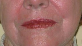 Up close of elderly woman's lower face showing lines and wrinkles to be treated from skin lasers