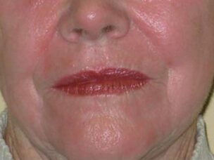 Up close of elderly woman's lower face showing lines and wrinkles to be treated from skin lasers