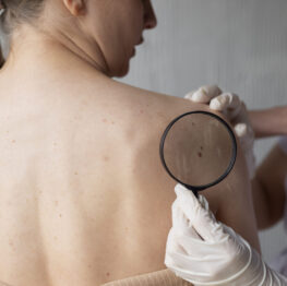 doctor diagnosing melanoma on female patient
