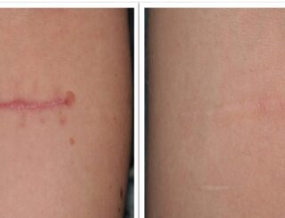 hypertrophicscarring_before1