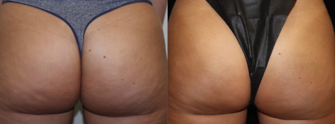 before and after of cellulite removal