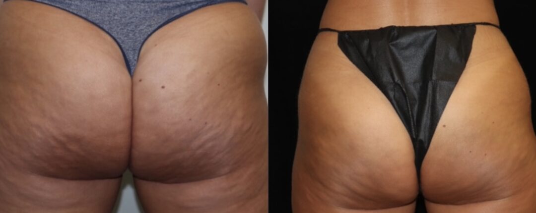 before and after of cellulite removal