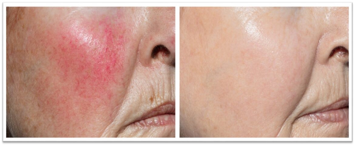 Before and after of Rosacea treatment from skin lasers