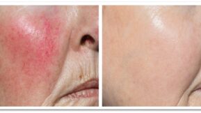 Before and after of Rosacea treatment from skin lasers