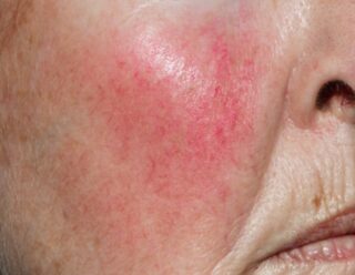 Before and after of Rosacea treatment from skin lasers