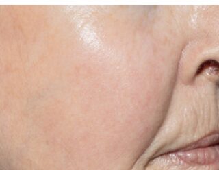 Skin Lasers for Rosacea Before and after of Rosacea treatment from skin lasers