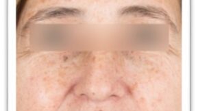 Woman's face with sun spots before treatment with skin lasers