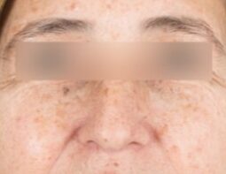 Woman's face with sun spots before treatment with skin lasers