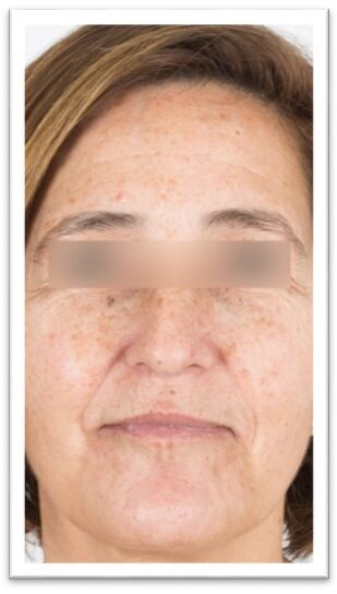 Woman's face with sun spots before treatment with skin lasers