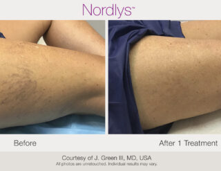 Before and after of varicose vein treatment from skin lasers