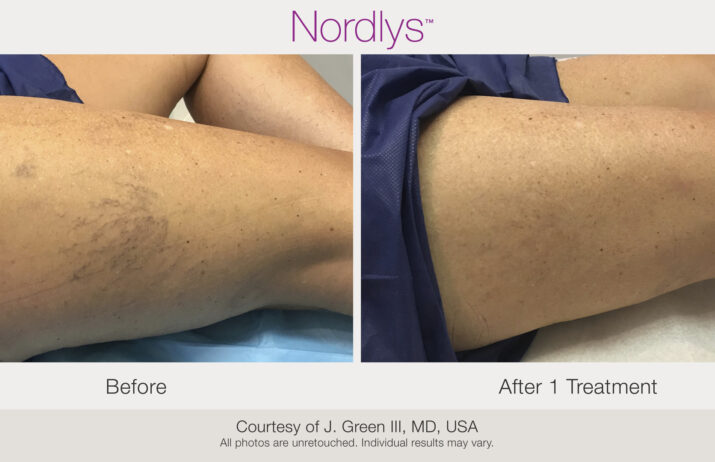 Before and after of varicose vein treatment from skin lasers