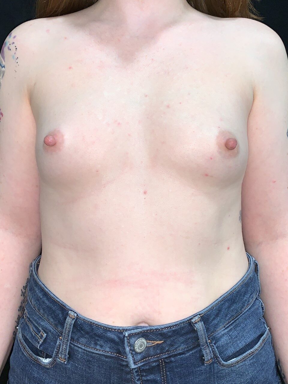 Breast augmentation Submuscular Asheville, North Carolina