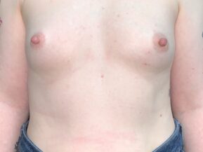 Breast augmentation Submuscular Asheville, North Carolina